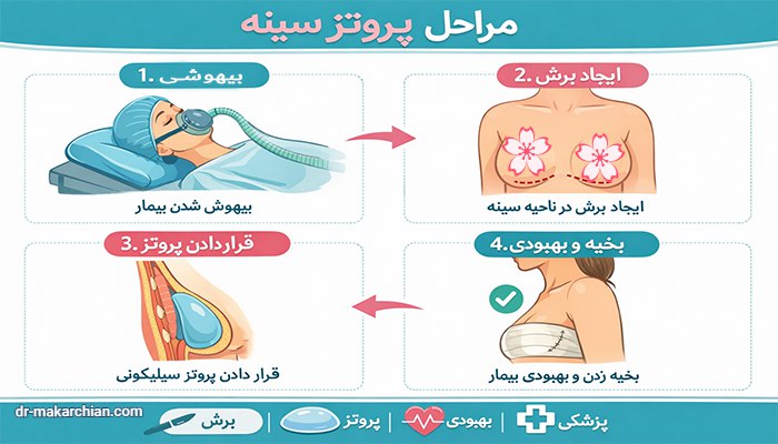 پروتز سینه