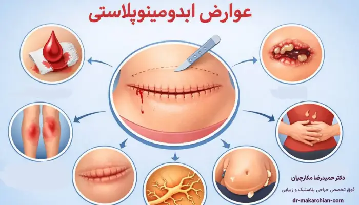 عوارض ابدومینوپلاستی